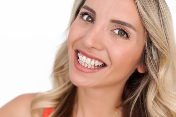 What You Need To Know About Adult Braces 