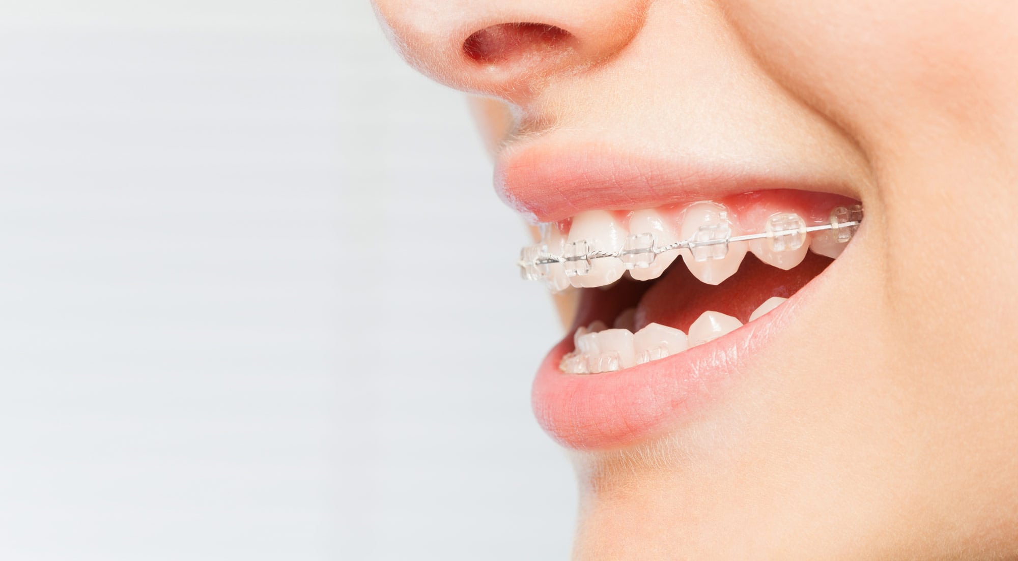 Damon Braces Can Improve Your Smile | Dr. Carr Orthodontics