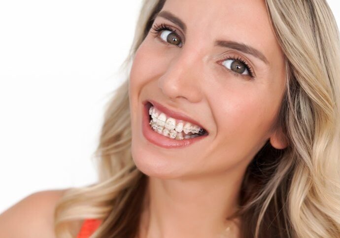 braces in Roy, Utah